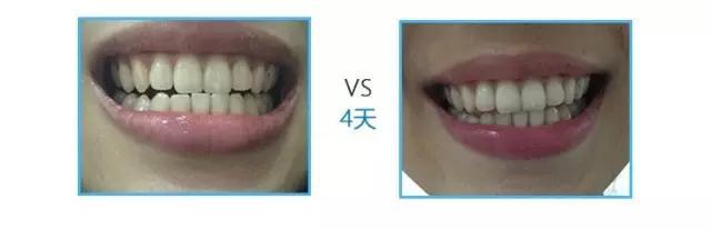 用了1年的健齿白，牙还这么黄，如何让我的笑容更有力量？